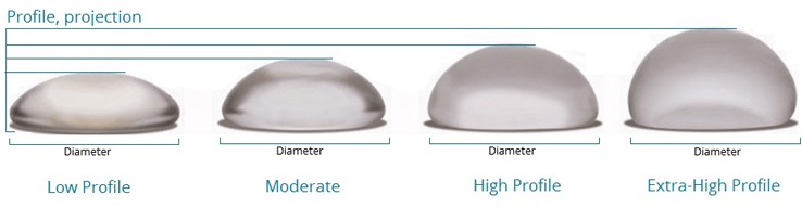 Projections Implants Mammaires